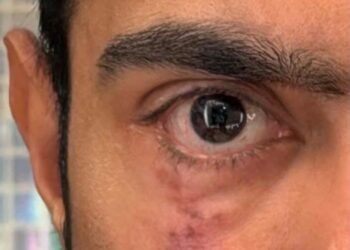 अमेरिका से अभिषेक ने आंख की तस्वीर के साथ पोस्ट किया संदेश